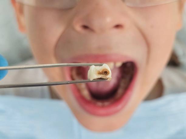Best Cracked Tooth Emergency Dentist  in Carrollton, GA
